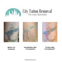 City Tattoo Removal image 4